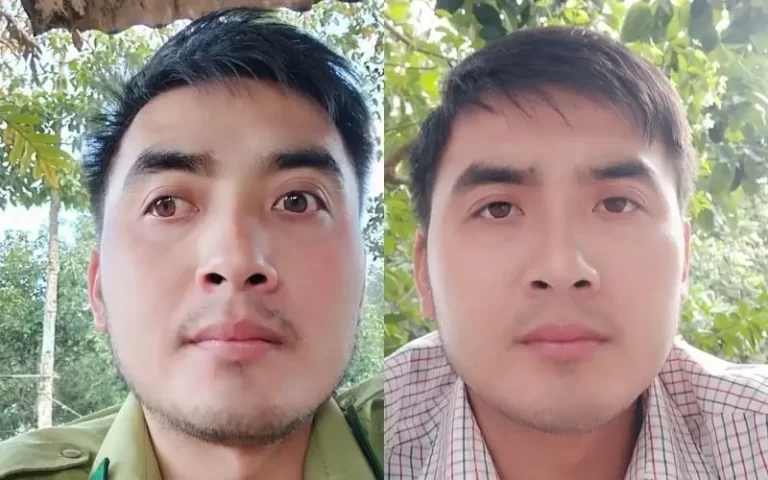 Hình ảnh trước và sau điều trị mắt lác tại Đông y Sơn Hà