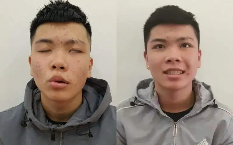 Phòng khám Đông y Sơn Hà Hình ảnh trước và sau điều trị liệt mặt tại Đông y Sơn Hà