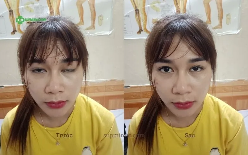 Phòng khám Đông y Sơn Hà Hình ảnh trước và sau điều trị mắt lác tại Đông y Sơn Hà