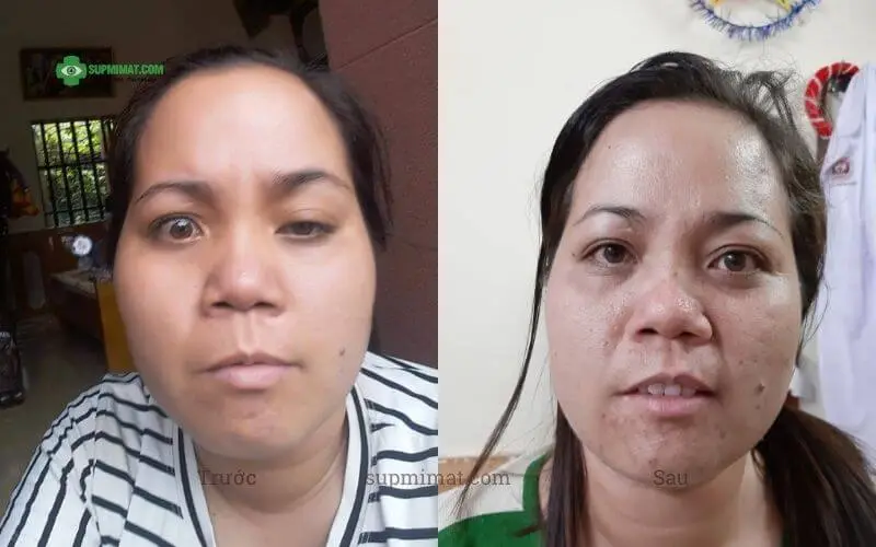 Phòng khám Đông y Sơn Hà Hình ảnh trước và sau điều trị mắt lác tại Đông y Sơn Hà