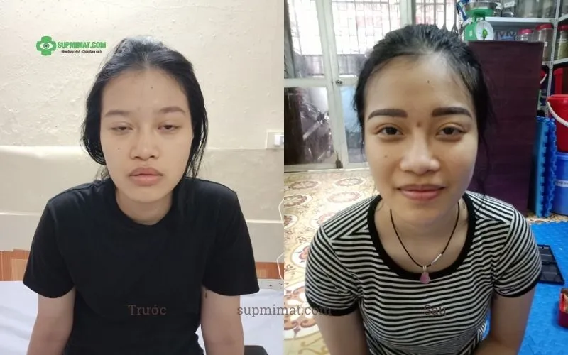 Phòng khám Đông y Sơn Hà Hình ảnh trước và sau điều trị mắt lác tại Đông y Sơn Hà