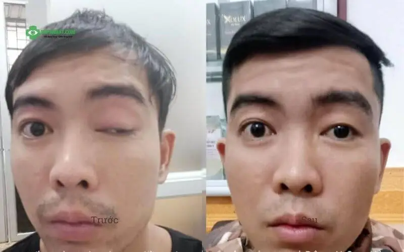Hình ảnh trước và sau điều trị mắt lác tại Đông y Sơn Hà