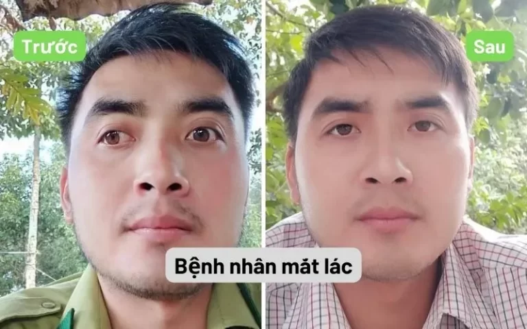 Bệnh nhân trước và sau điều trị mắt lác tại Đông y Sơn Hà