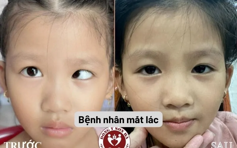 Phòng khám Đông y Sơn Hà Bệnh nhân trước và sau điều trị mắt lác tại Đông y Sơn Hà