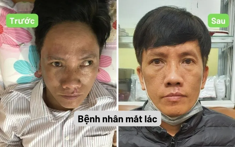 Phòng khám Đông y Sơn Hà Bệnh nhân trước và sau điều trị mắt lác tại Đông y Sơn Hà