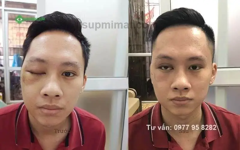 Hình ảnh trước và sau điều trị mắt lác tại Đông y Sơn Hà