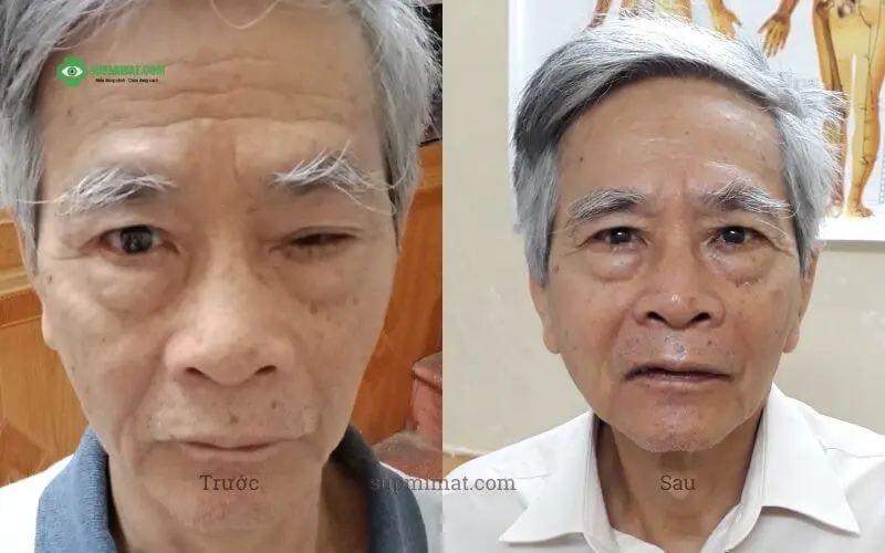 Phòng khám Đông y Sơn Hà Hình ảnh trước và sau điều trị mắt lác tại Đông y Sơn Hà