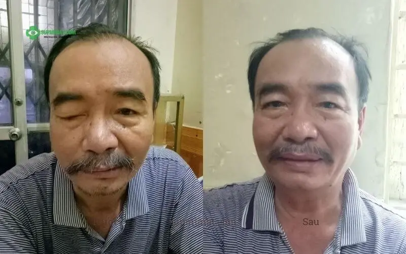 Phòng khám Đông y Sơn Hà Hình ảnh trước và sau điều trị mắt lác tại Đông y Sơn Hà
