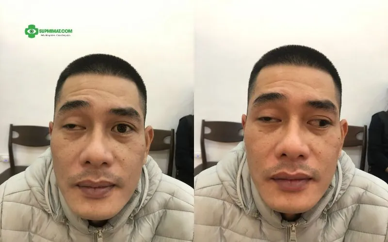 Phòng khám Đông y Sơn Hà Hình ảnh trước và sau điều trị mắt lác tại Đông y Sơn Hà