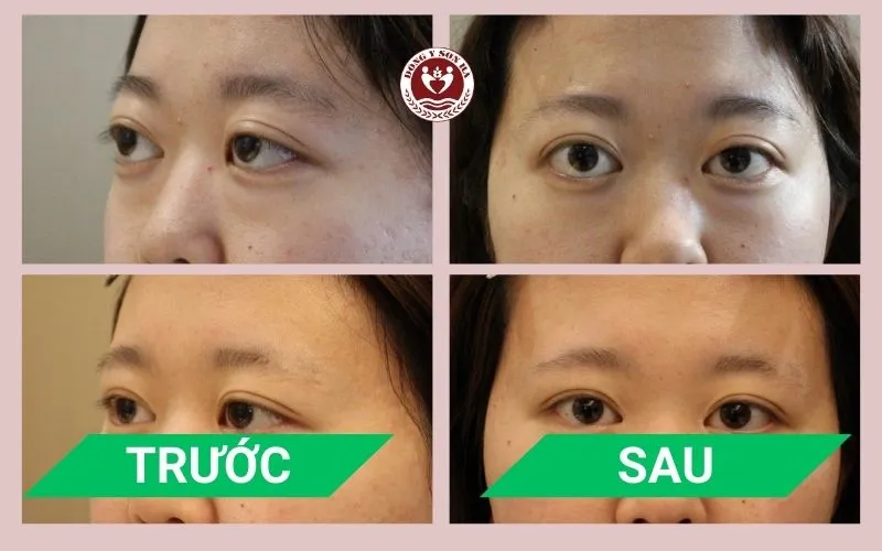 Phòng khám Đông y Sơn Hà Hình ảnh trước và sau điều trị mắt lồi tại Đông y Sơn Hà