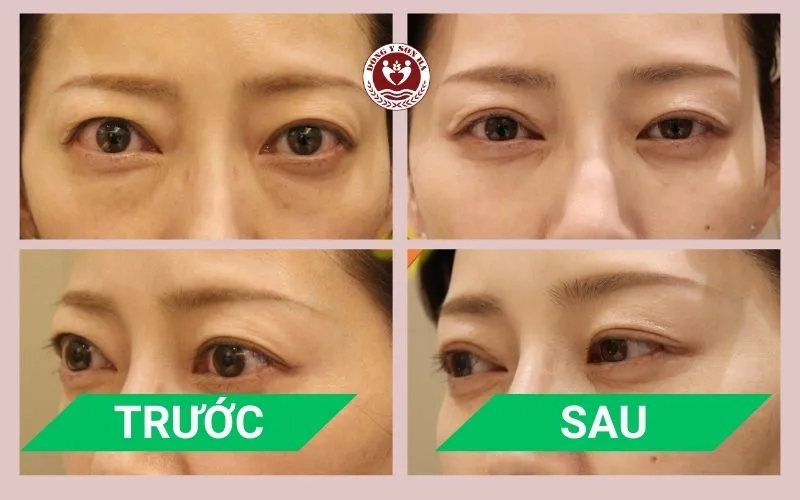 Phòng khám Đông y Sơn Hà Hình ảnh trước và sau điều trị mắt lồi tại Đông y Sơn Hà