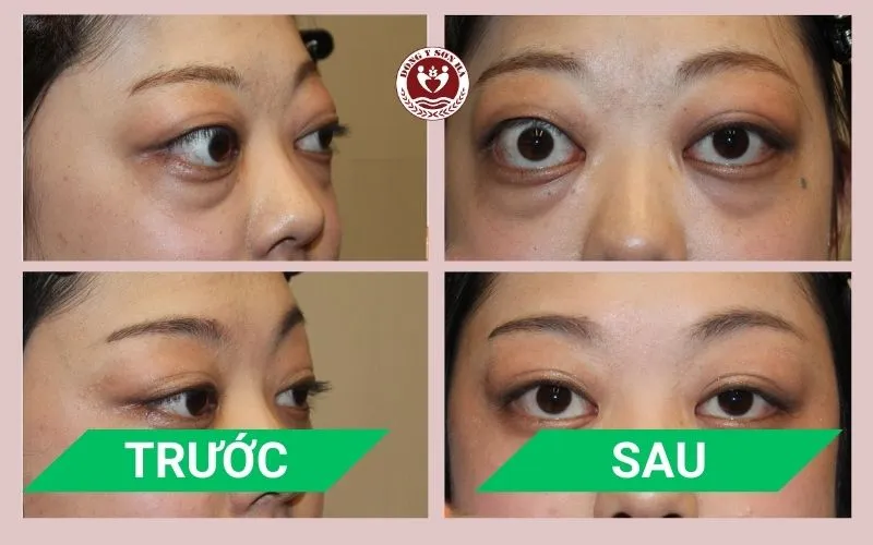 Phòng khám Đông y Sơn Hà Hình ảnh trước và sau điều trị mắt lồi tại Đông y Sơn Hà