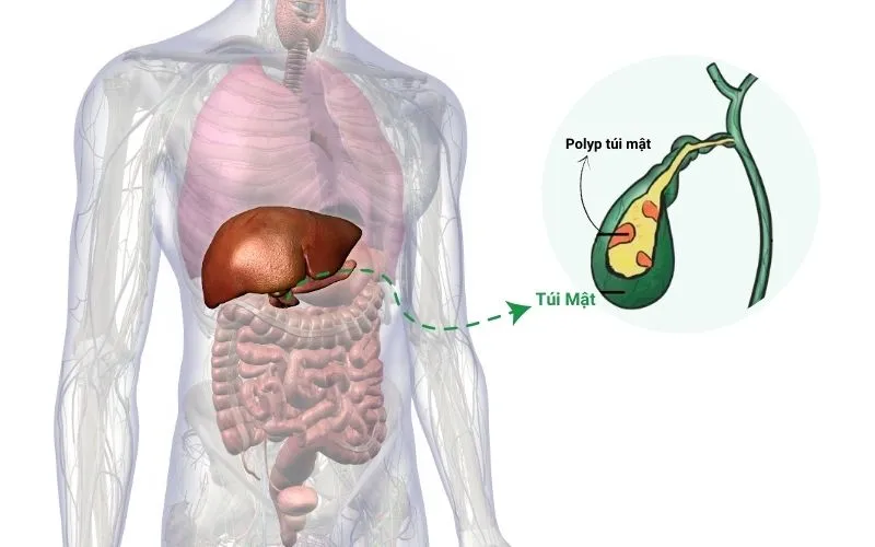 Hóa Ứ Tiêu Tích Lợi Đởm Thang: Bài thuốc Nam điều trị polyp túi mật hiệu quả | Đông y Sơn Hà Polyp tui mat