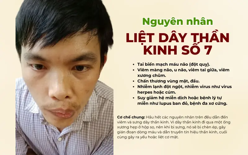 Nguyên nhân gây liệt dây thần kinh số 7