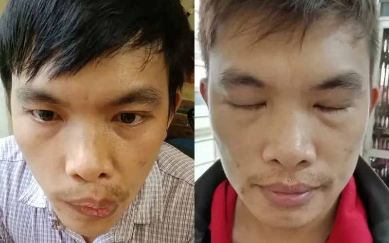 Hình ảnh trước & sau điều trị liệt 7 tại Đông y Sơn Hà