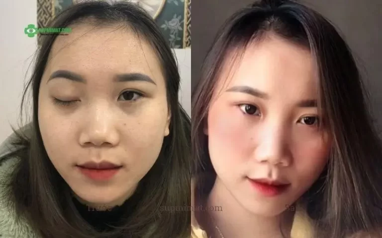 Hình ảnh trước và sau điều trị sụp mi biến chứng tiêm boto.x