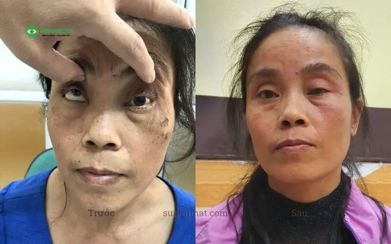 dieu tri sup mi mat sau tai nan 01