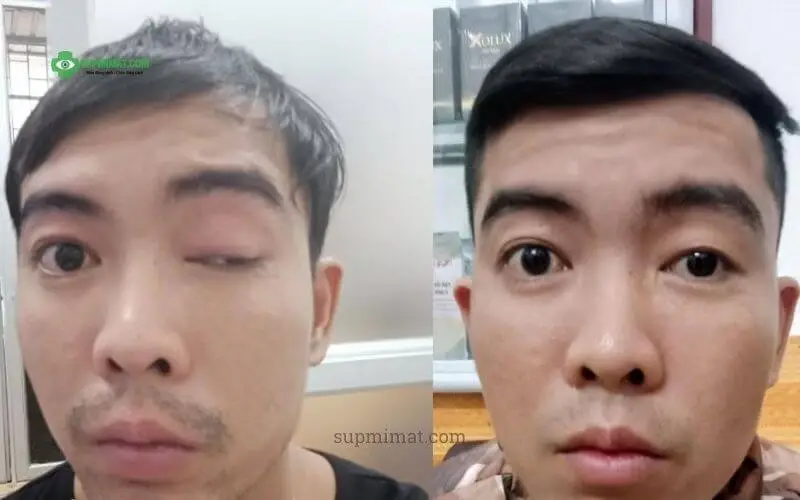 Hình ảnh trước và sau điều trị sụp mi sau tai nạn