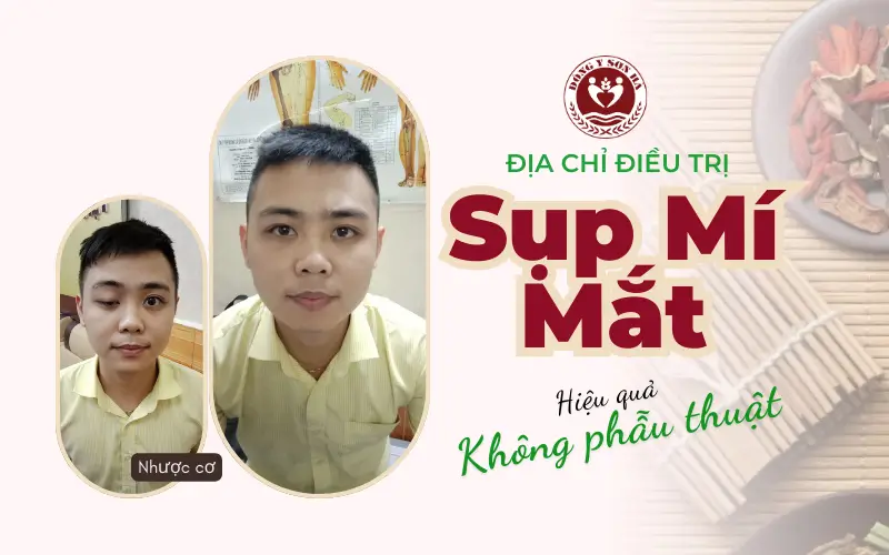 Phòng khám Đông y Sơn Hà chuyên điều trị sụp mí mắt không phẫu thuật