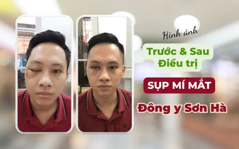 Hình ảnh trước & sau điều trị sụp mí mắt tại Đông y Sơn Hà