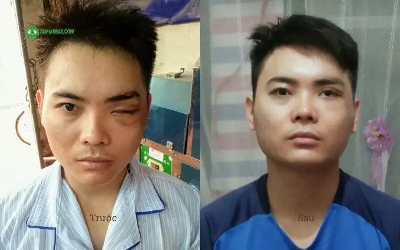 Hình ảnh trước và sau điều trị sụp mi do tổn thương dây thần kinh 3 sau tai nạn