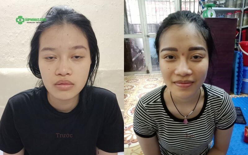 hinh-anh-truoc-va-sau-chua-sup-mi-mat-khong-phau-thuat7.jpg