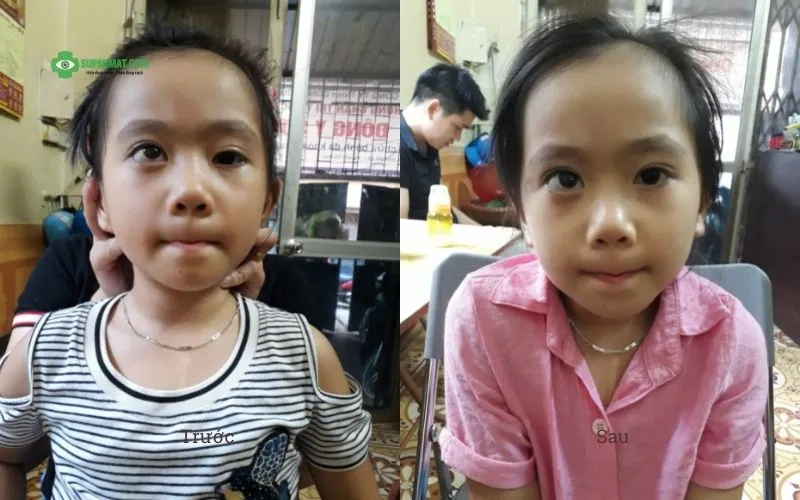Hình ảnh trước và sau điều trị sụp mi bẩm sinh