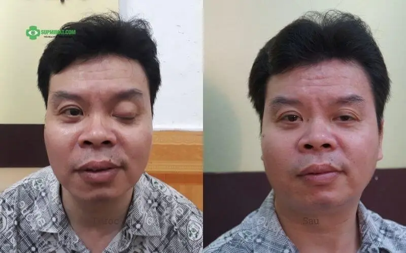 Hình ảnh trước và sau điều trị sụp mi liệt dây thần kinh III