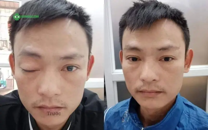 Hình ảnh trước và sau điều trị sụp mi do tổn thương dây thần kinh 3