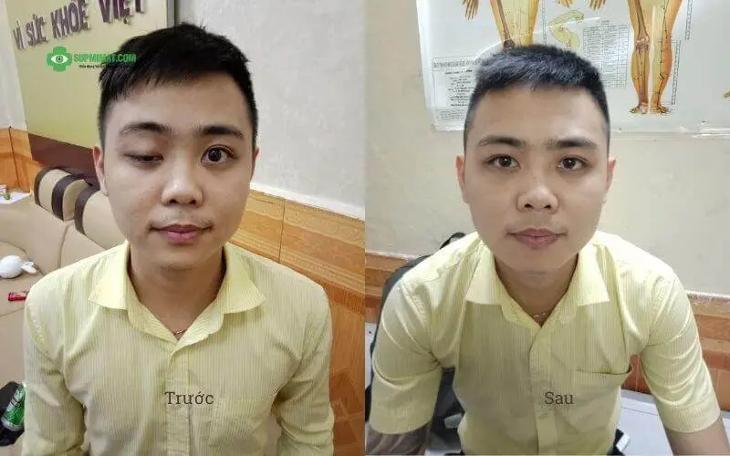 hinh-anh-truoc-va-sau-dieu-tri-sup-mi-mat-do-ton-thuong-day-than-kinh.webp