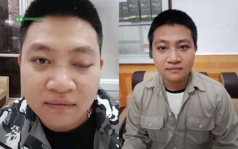 hinh anh truoc va sau dieu tri sup mi mat khong phau thuat 1