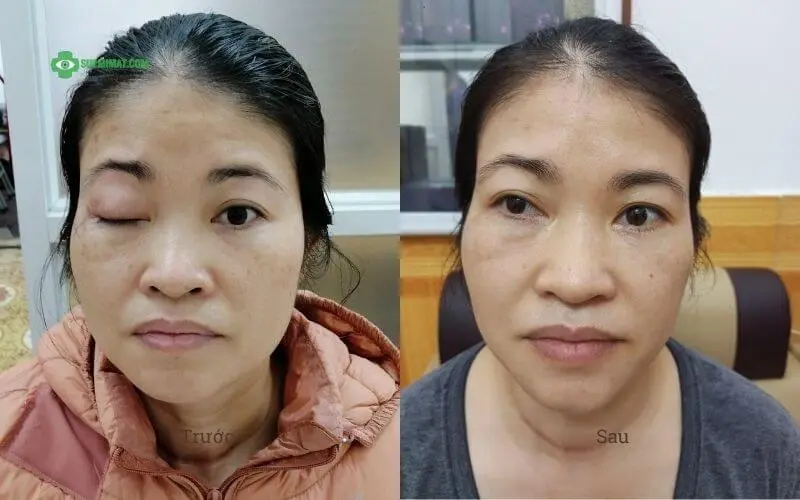 Hình ảnh trước và sau điều trị sụp mi do tổn thương dây thần kinh 3 do biến chứng bệnh tiểu đường