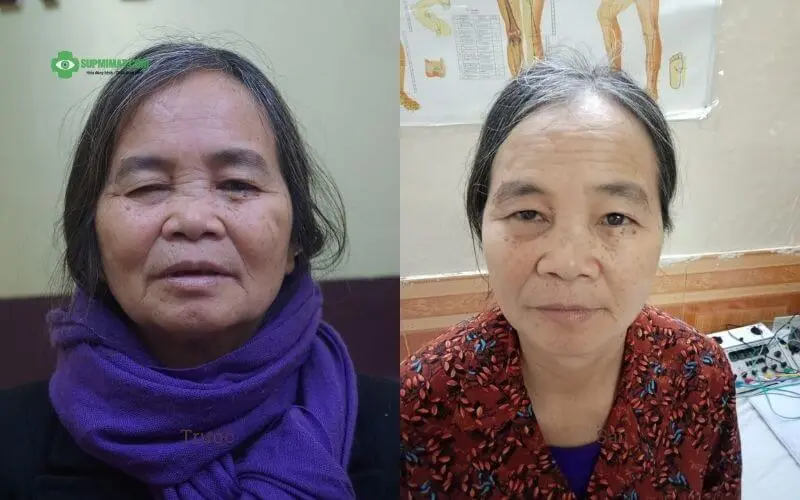 hinh anh truoc va sau dieu tri sup mi mat khong phau thuat3