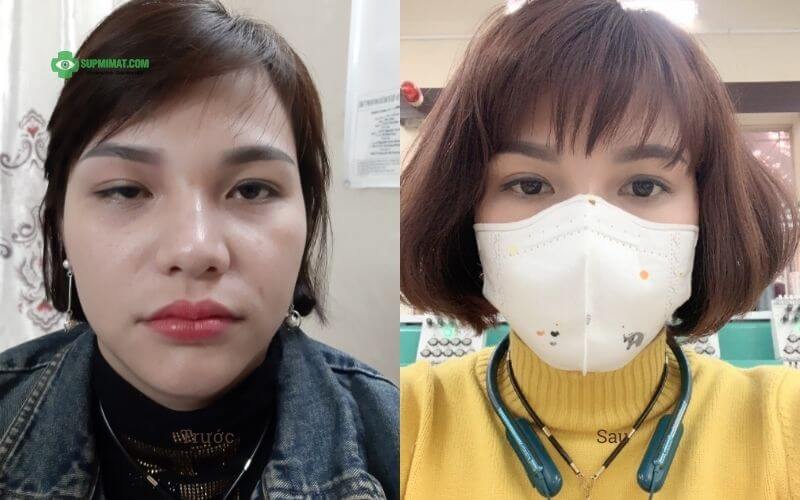 Hình ảnh trước và sau điều trị sụp mi do biến chứng sau tiêm Boto.x