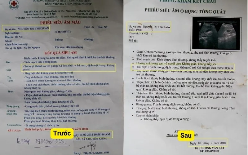 Hóa Ứ Tiêu Tích Lợi Đởm Thang: Bài thuốc Nam điều trị polyp túi mật hiệu quả | Đông y Sơn Hà ket-qua-truoc-sau-dieu-tri-polyp-tui-mat-tai-dong-y-son-ha-Bn-Xuan-Ha_noi.webp