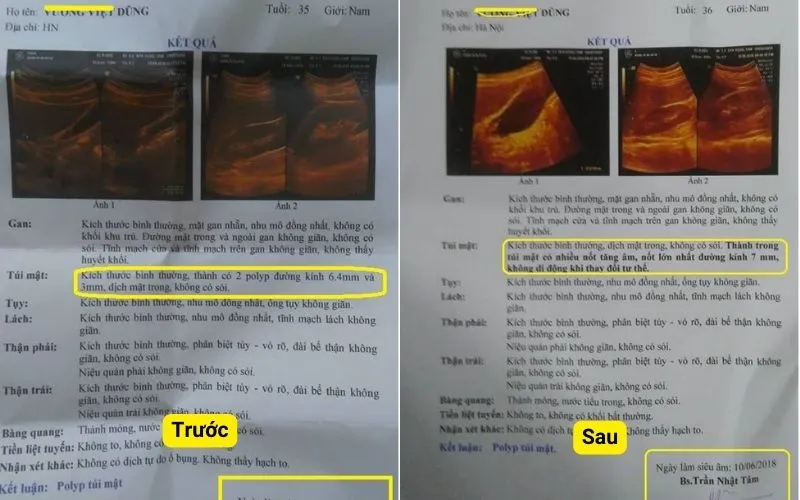 Hóa Ứ Tiêu Tích Lợi Đởm Thang: Bài thuốc Nam điều trị polyp túi mật hiệu quả | Đông y Sơn Hà ket-qua-truoc-sau-dieu-tri-polyp-tui-mat-tai-dong-y-son-ha-bn-Dung-Ha-Noi.webp