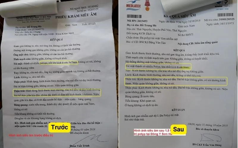 Hóa Ứ Tiêu Tích Lợi Đởm Thang: Bài thuốc Nam điều trị polyp túi mật hiệu quả | Đông y Sơn Hà ket-qua-truoc-sau-dieu-tri-polyp-tui-mat-tai-dong-y-son-ha-bn-Ha-Thai_nguyen.webp