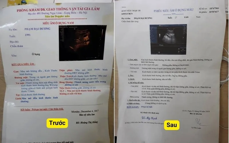 Hóa Ứ Tiêu Tích Lợi Đởm Thang: Bài thuốc Nam điều trị polyp túi mật hiệu quả | Đông y Sơn Hà ket-qua-truoc-sau-dieu-tri-polyp-tui-mat-tai-dong-y-son-ha-bn-duong-gia-lam-Ha_noi.webp