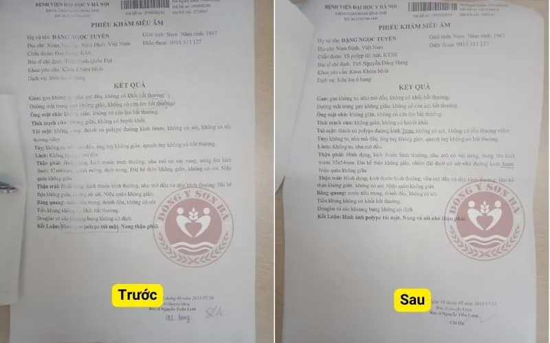 Hóa Ứ Tiêu Tích Lợi Đởm Thang: Bài thuốc Nam điều trị polyp túi mật hiệu quả | Đông y Sơn Hà ket-qua-truoc-sau-dieu-tri-polyp-tui-mat-tai-dong-y-son-ha-bn-tuyen-nam-dinh.webp