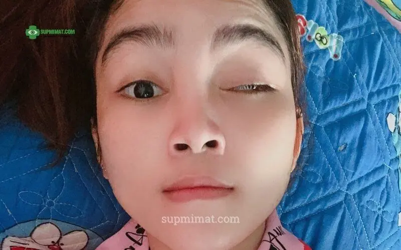 Tìm Hiểu Về 12 Đôi Dây Thần Kinh Sọ: Cấu Trúc, Chức Năng Và Bệnh Thường Gặp Triệu chứng Liệt dây thần kinh số III