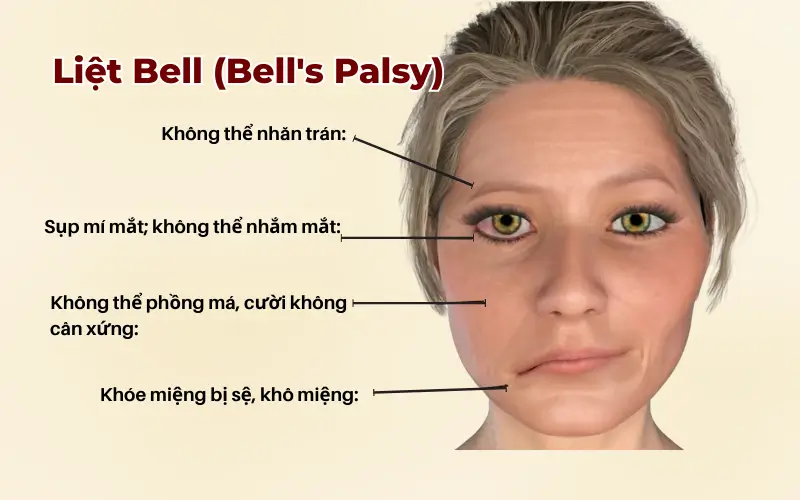 Liệt Bell (Bell's Palsy): là nguyên nhân phổ biến nhất, chiếm tỷ lệ lớn trong các trường hợp liệt dây thần kinh số 7