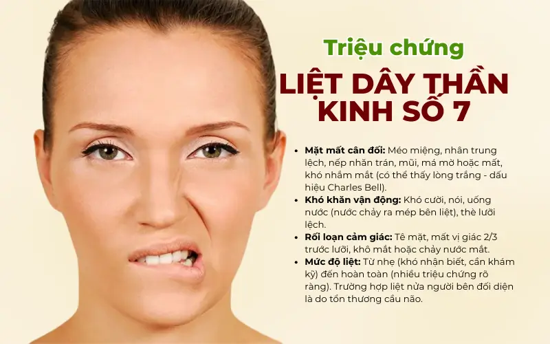 Triệu chứng Liệt Dây Thần Kinh Số 7 (Liệt Mặt)