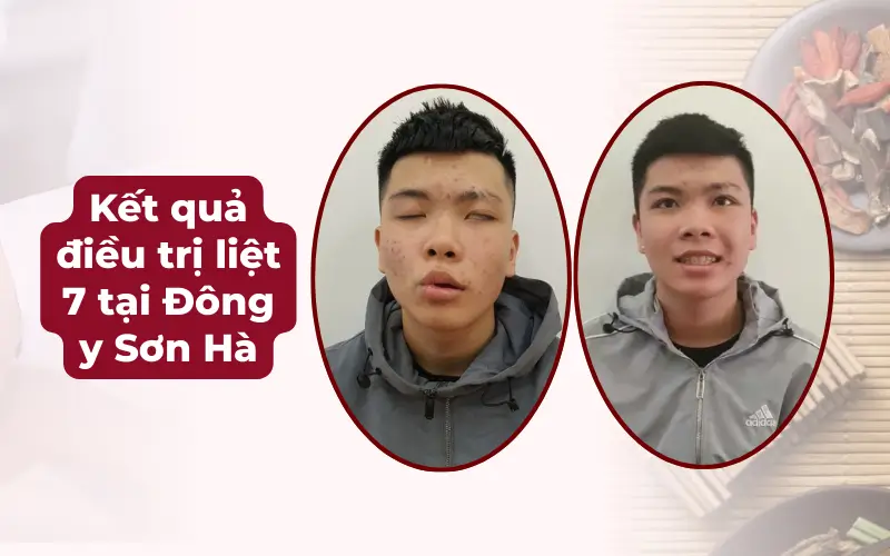 Điều trị liệt dây thần kinh 7 bằng châm cứu kết hợp uống thuốc Đông y tại phòng khám Đông y Sơn Hà
