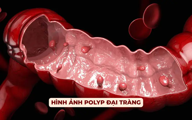 Polyp Đại Tràng: Nguyên Nhân, Triệu Chứng, Chẩn Đoán và Điều Trị Từ A-Z Hình ảnh polyp đại tràng