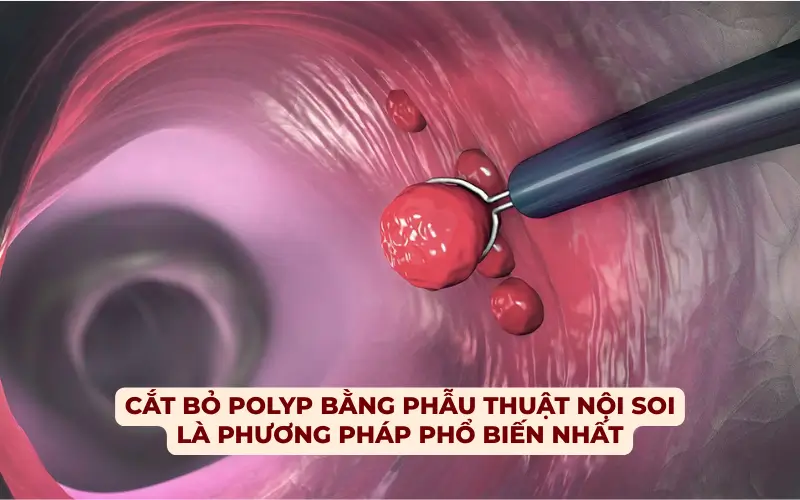 Polyp Đại Tràng: Nguyên Nhân, Triệu Chứng, Chẩn Đoán và Điều Trị Từ A-Z Cắt bỏ polyp bằng nội soi là phương pháp phổ biến nhất hiện nay