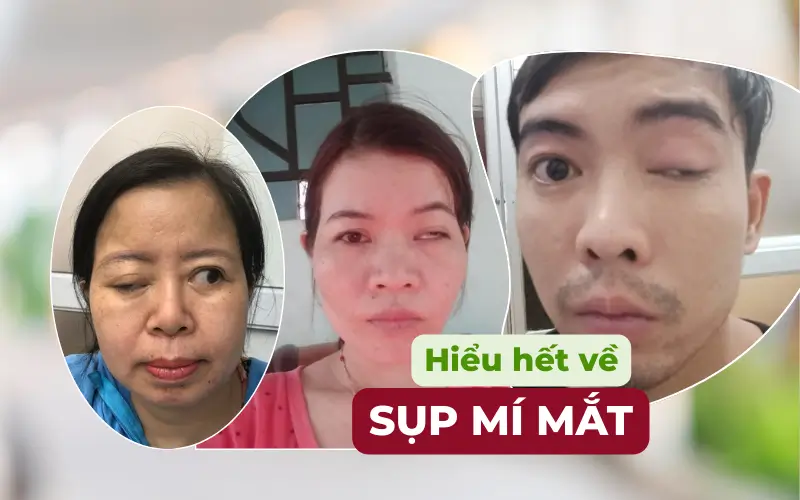 Sụp Mí Mắt (Ptosis): Phân Tích Chuyên Sâu Về Phân Loại, Cơ Chế Bệnh Sinh, Chẩn Đoán và Hướng Điều Trị (cập nhật 2025) Sụp Mí Mắt