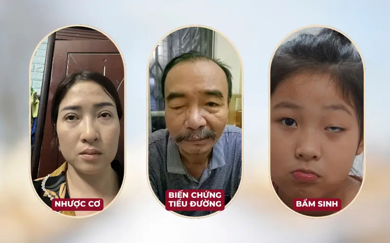 Sụp Mí Mắt (Ptosis): Phân Tích Chuyên Sâu Về Phân Loại, Cơ Chế Bệnh Sinh, Chẩn Đoán và Hướng Điều Trị (cập nhật 2025) Sụp Mí Mắt Có thể do nhiều nguyên nhân khác nhau như lão hóa, bẩm sinh, chấn thương, hoặc bệnh lý.