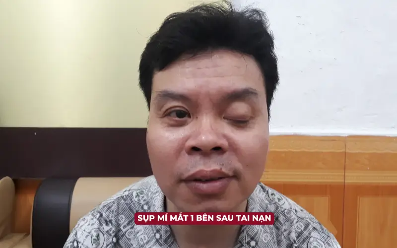 Sụp Mí Mắt (Ptosis): Phân Tích Chuyên Sâu Về Phân Loại, Cơ Chế Bệnh Sinh, Chẩn Đoán và Hướng Điều Trị (cập nhật 2025) Sụp mí mắt 1 bên sau tai nạn do tổn thương dây thần kinh số 3