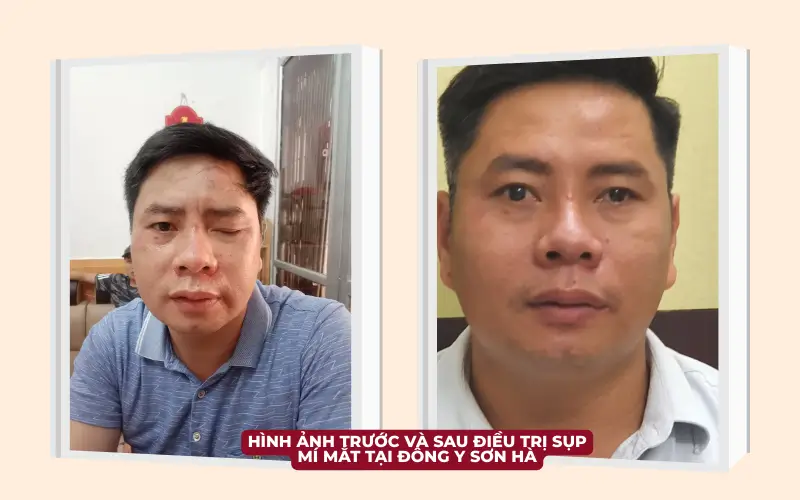 Sụp Mí Mắt (Ptosis): Phân Tích Chuyên Sâu Về Phân Loại, Cơ Chế Bệnh Sinh, Chẩn Đoán và Hướng Điều Trị (cập nhật 2025) Hình ảnh trước và sau điều trị sụp mí mắt do tổn thương dây thần kinh vận nhãn (TK số III).