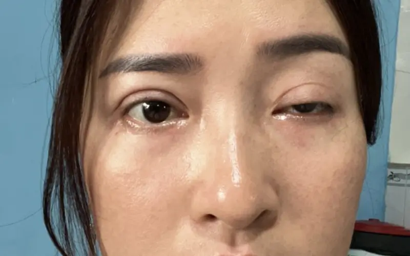 sụp mí mắt do nhược cơ